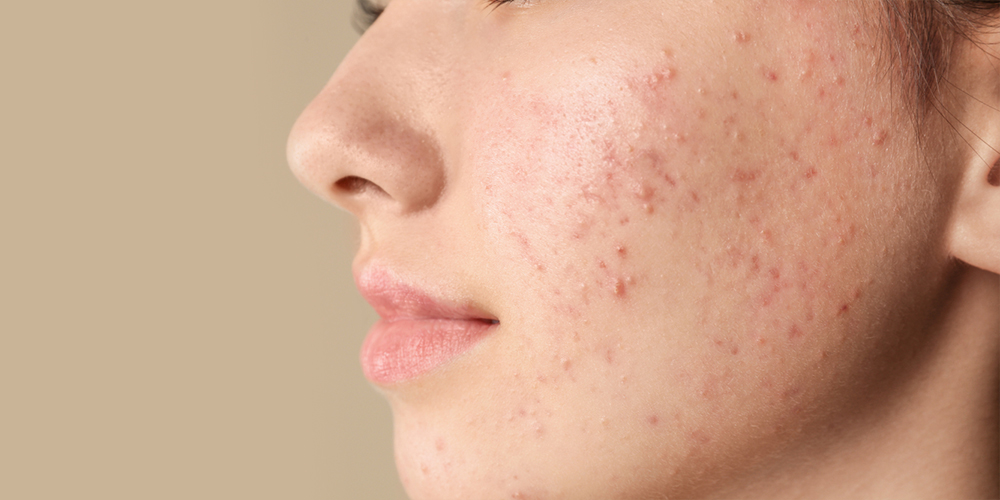 acne-homeopathy-treatment-in-panvel