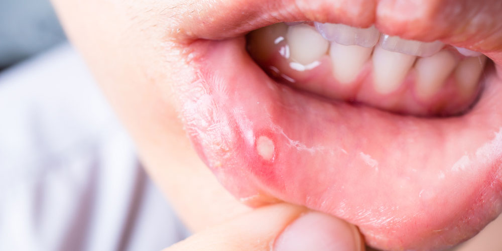close-up-of-asian-woman-with-aphtha-on-lip-ulcer-homepathy-treatment
