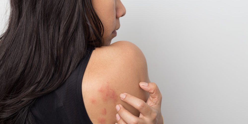 with-allergy-rash-urticaria-symptoms-homeopathy-treatment-panvel